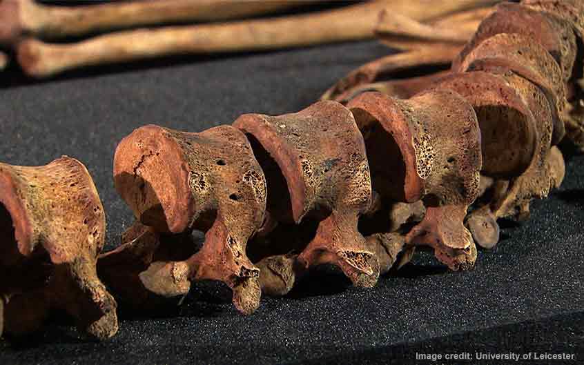 King Richard III's spine showing scoliosis