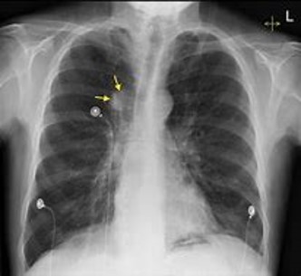 X-rays showing potential lung cancer