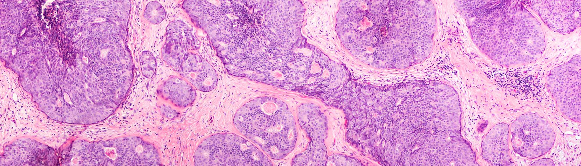 cancer cell under a microscope