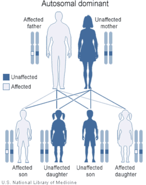 Punnett square of an affected father who is carrying a gene for a disease that is dominant (heterozygous) whilst the mother is unaffected and does not carry the gene (homozygous recessive). The chances of their children being affected by the disease is 50%. 