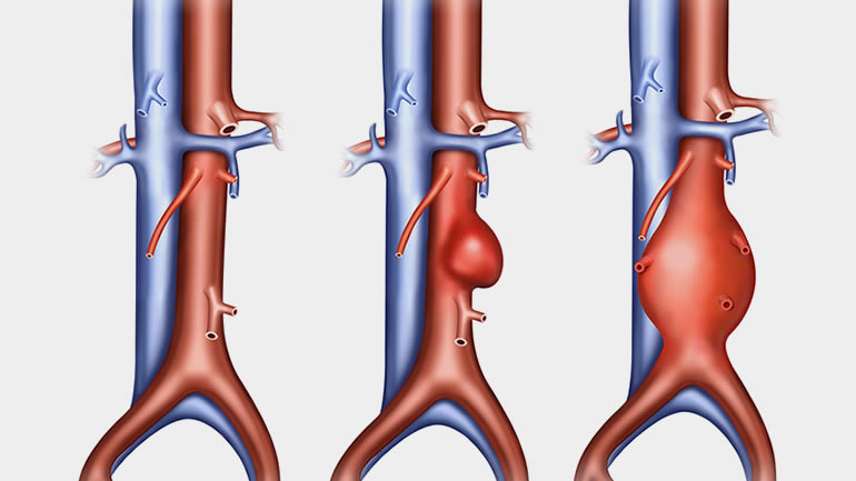 Illustration of abdominal arteries with two different types of aneurysm