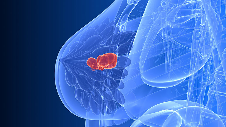 Illustration of a breast cancer tumour
