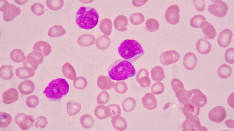 Chronic lymphocytic leukaemia