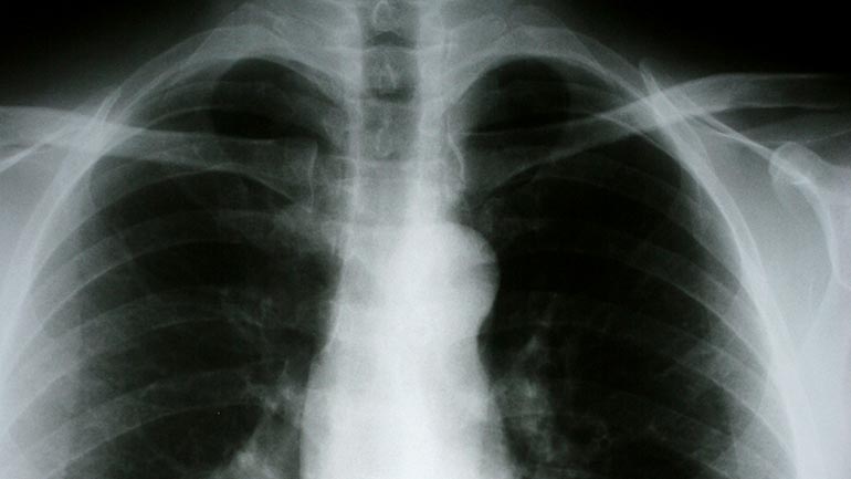 chest xray showing lungs