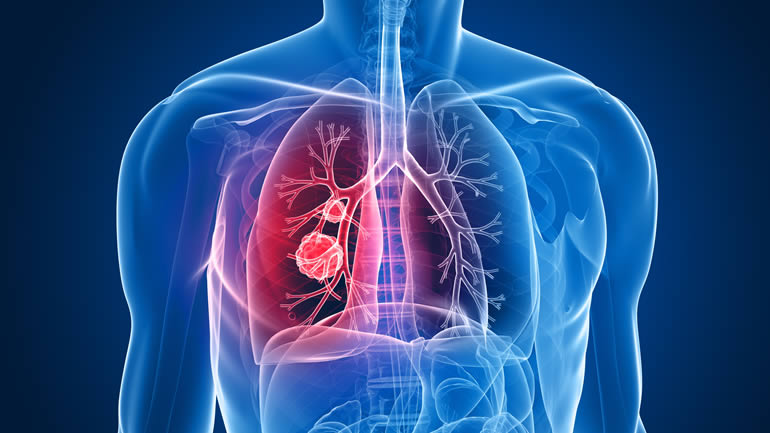 what is the life expectancy of stage 4 lung cancer