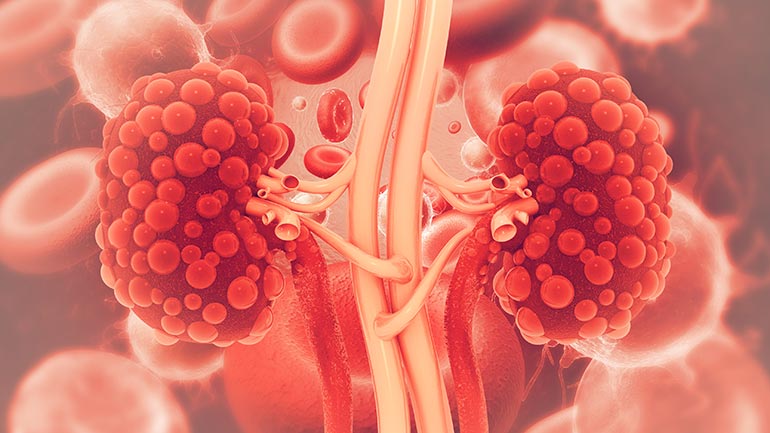 Diseased kidneys