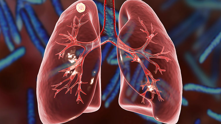 Illustration of lungs infected with tuberculosis