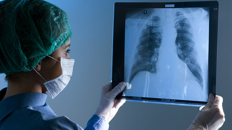 Physician holding up an x-ray of human lungs