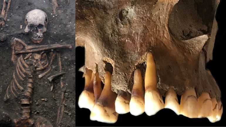 Skeleton of an adult male from 14th Century Cambridge who had herpes, alongside a close-up of the teeth of a pipe-smoking Dutchman from the 17th Century.