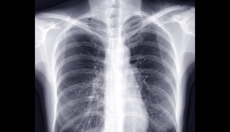 Covid chest CT scan