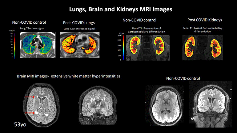 MRI images