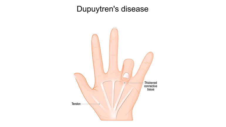 Dupuytren’s Contracture (Getty image)