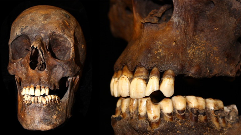 Multiple angles of a skull showing distinctive wear on the teeth indicating tobacco use.