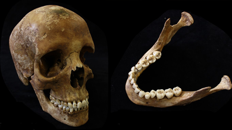 Example of a skull that does not show evidence of tobacco use. It has a complete set of teeth and show no signs of wear. 