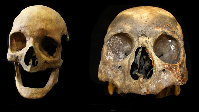 An example of a skull without teeth which would have previously been difficult to analyse for tobacco use. 