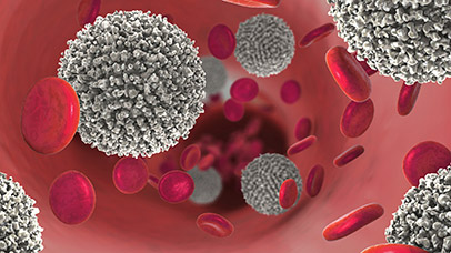 haematological malignancies under a microscope 