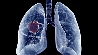 Lung tumour, computer illustration.
