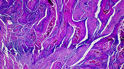 Squamous cell carcinoma cancer cells