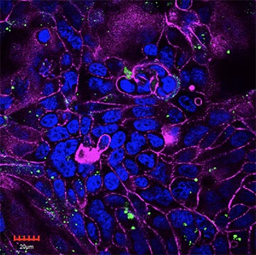 Neelam Dave The Damage Bacteria Can Do