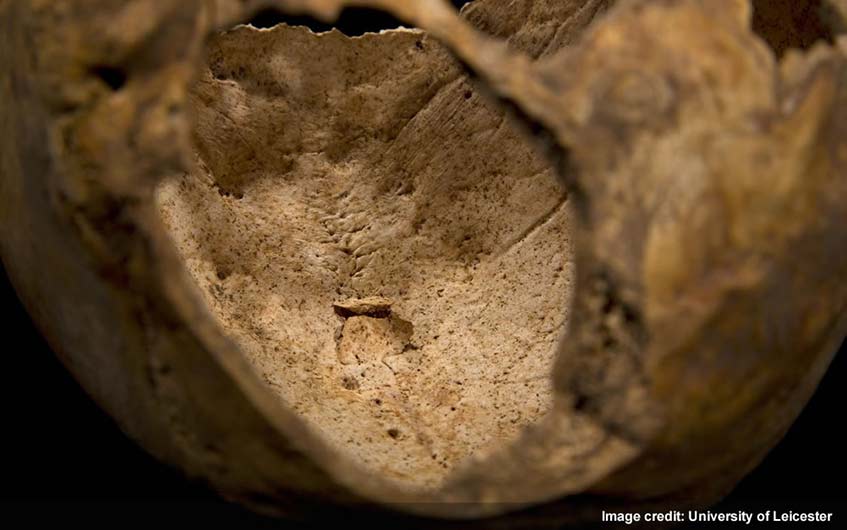 Small penetrating wound on the top of Richard III's skull