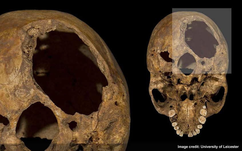 Large hole underneath back of Richard III's skull