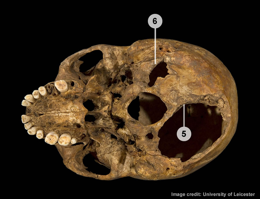 Large hole underneath back of and on left base of Richard III's skull