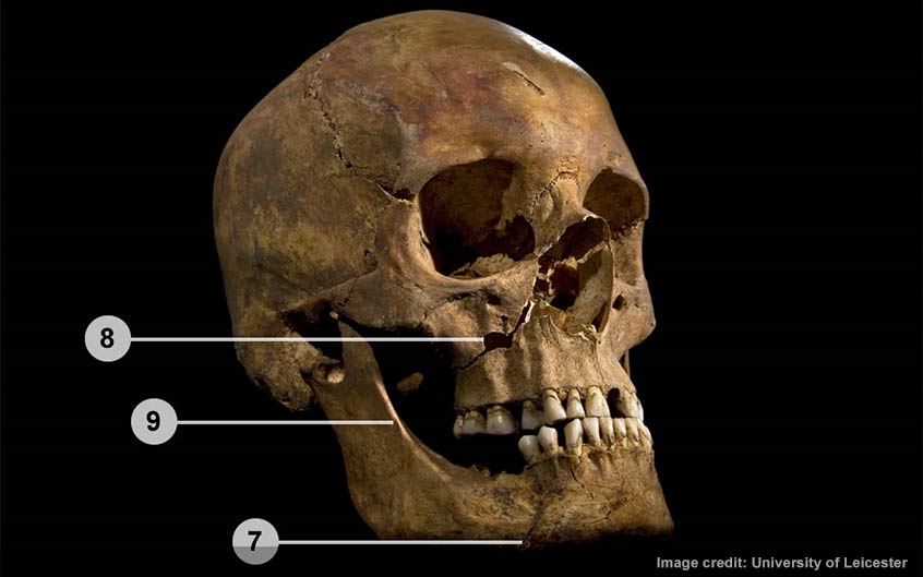 Wounds to the lower jaw and right cheek (injuries 7-9)