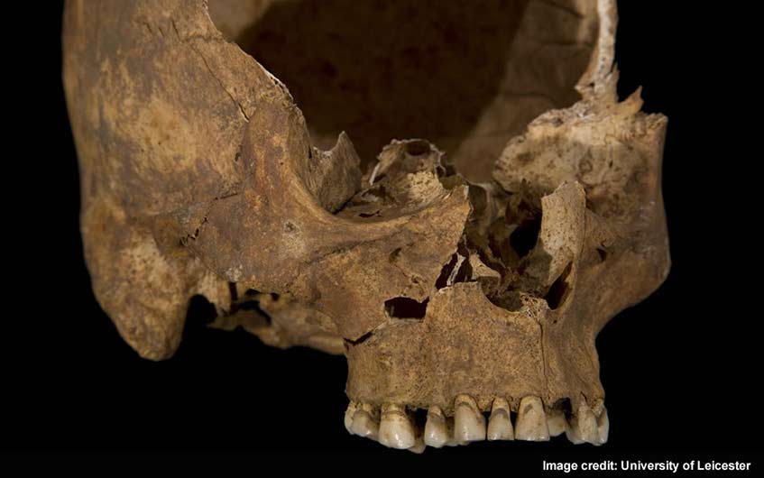 Hole in Richard III's right cheek