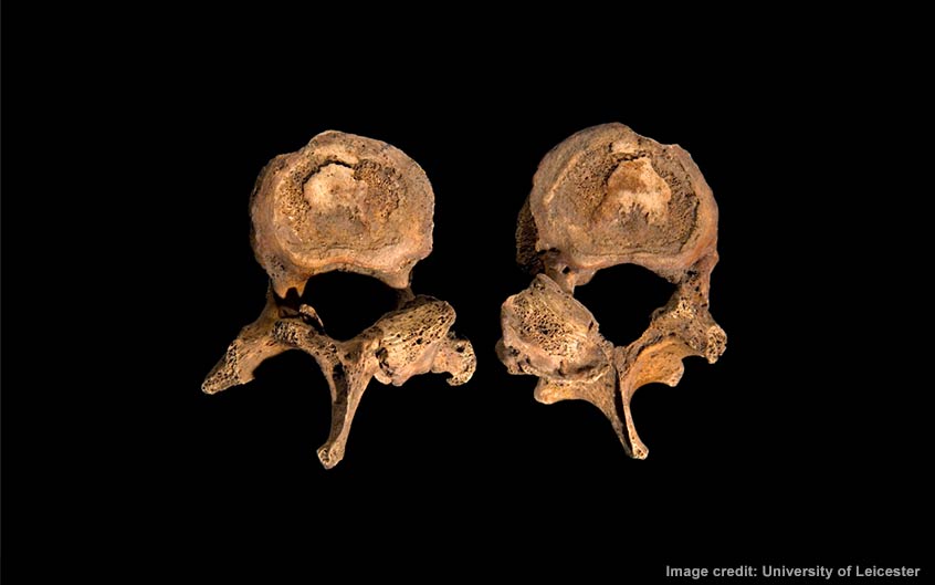 Two vertebrae showing some abnormal features relating to the scoliosis.