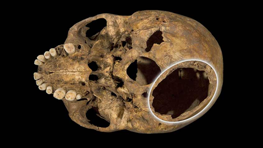 A hole in the back of King Richard III's skull