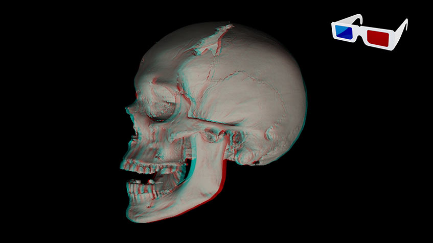 Micro-CT Scan of Richard III’s Skull 