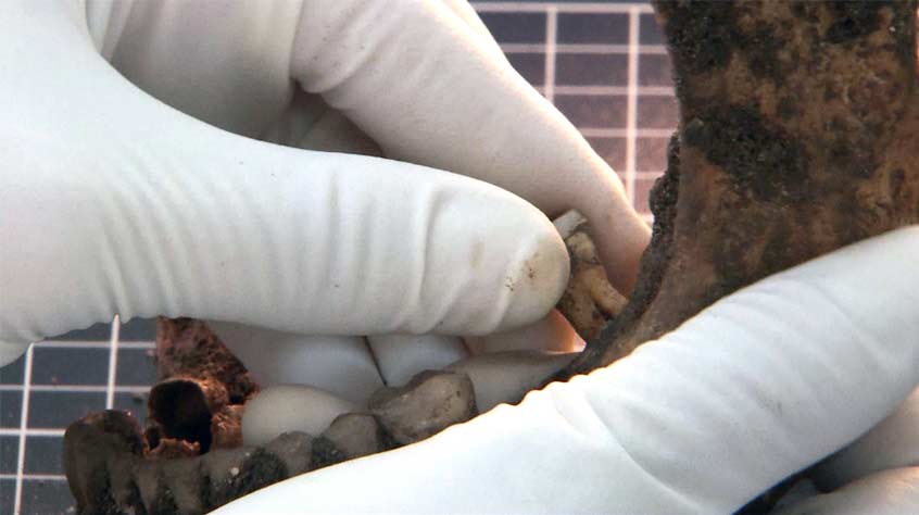 Removing a Tooth for DNA Analysis